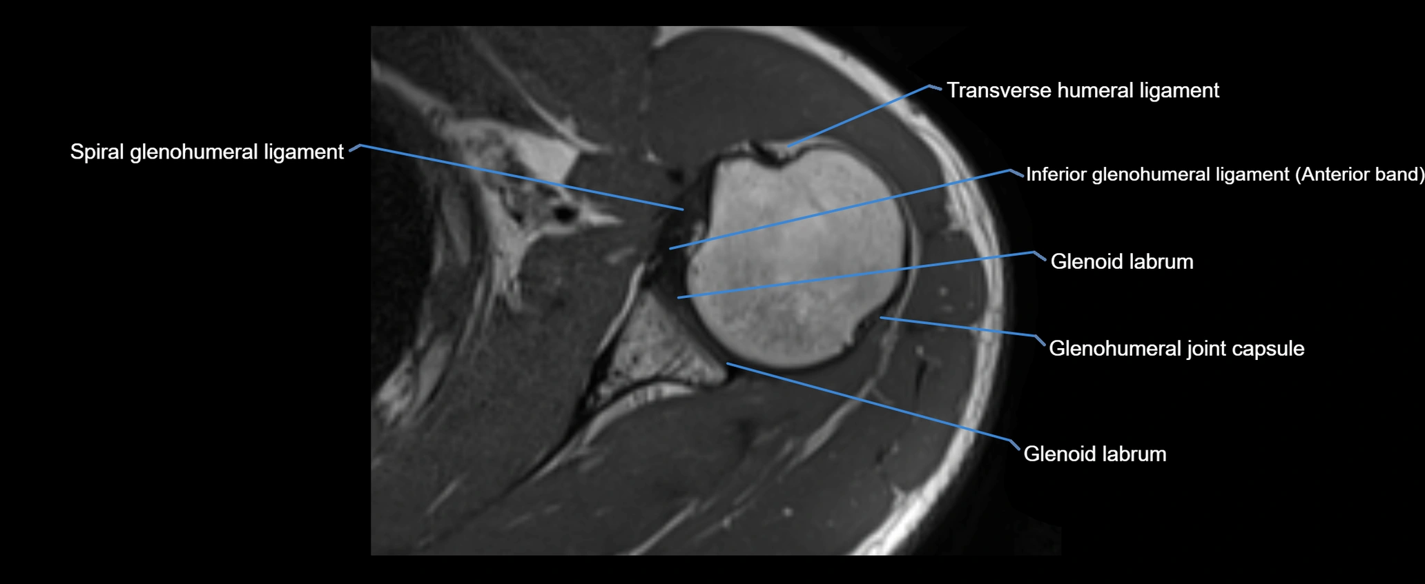 shoulder ligaments axial 3d 3t mri image-img-00005-00071.webp